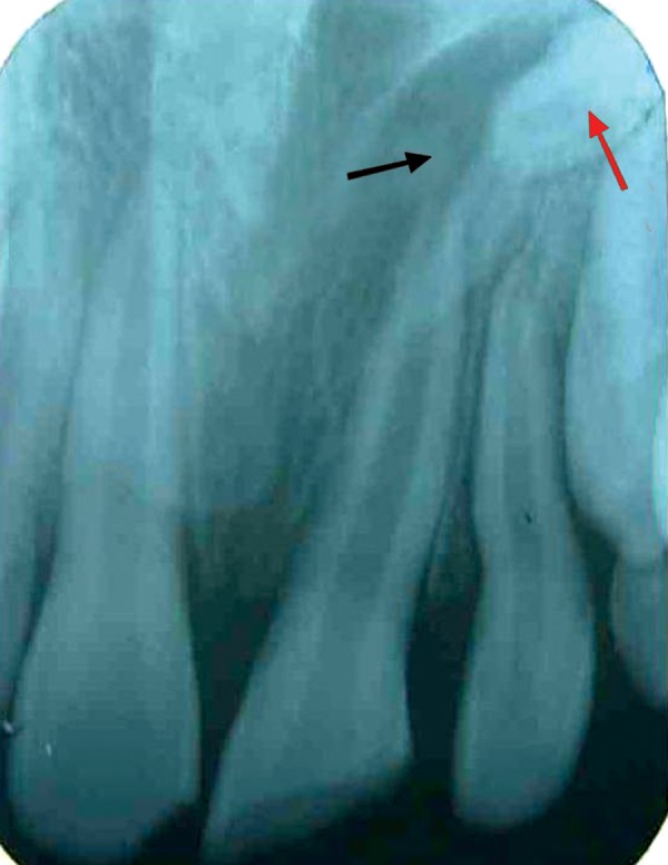 Surgical Management Of Palatal Placed Inverted Dilacerated And