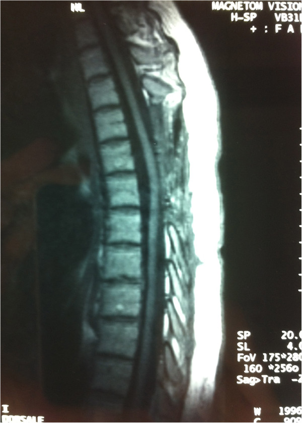 Thoracic Spinal Cord Cavernous Angioma A Case Report And Review Of The