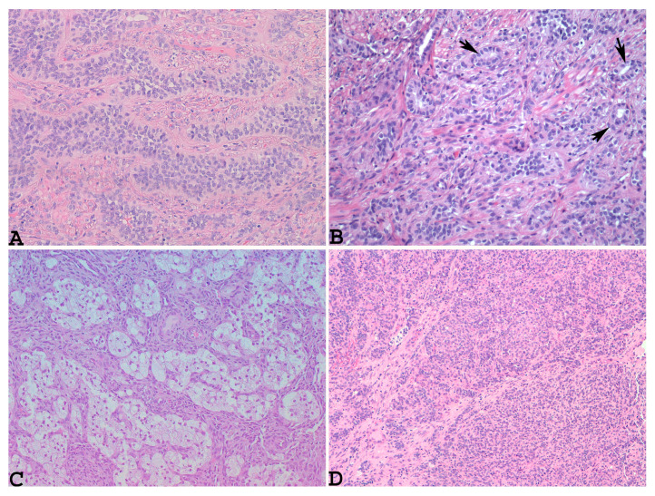 Uterine Tumor Resembling Ovarian Sex Cord Tumor Utrosct A Rare