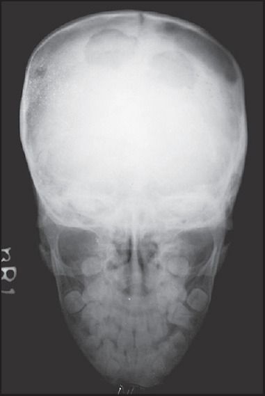 Atypical Lytic Lesions Of Skull Clinical And Radiological Correlation