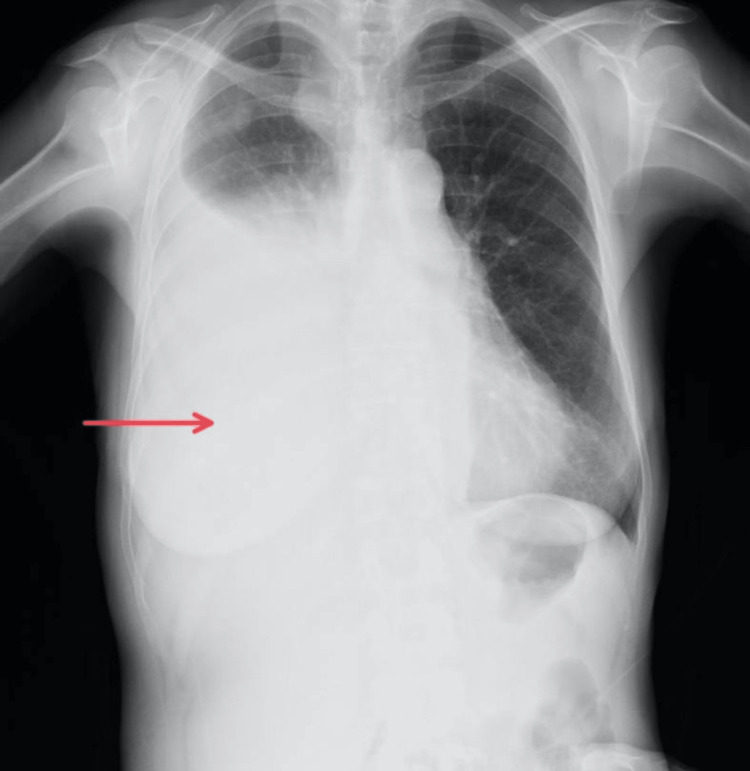 Intrapleural Fibrinolytic Therapy With Alteplase For The Management Of