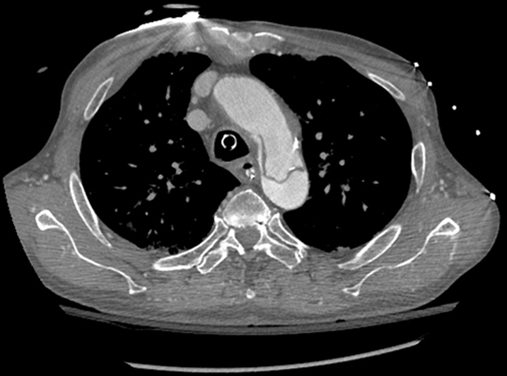 A Case Of An Aortic Dissection After Mechanical Chest Compression By