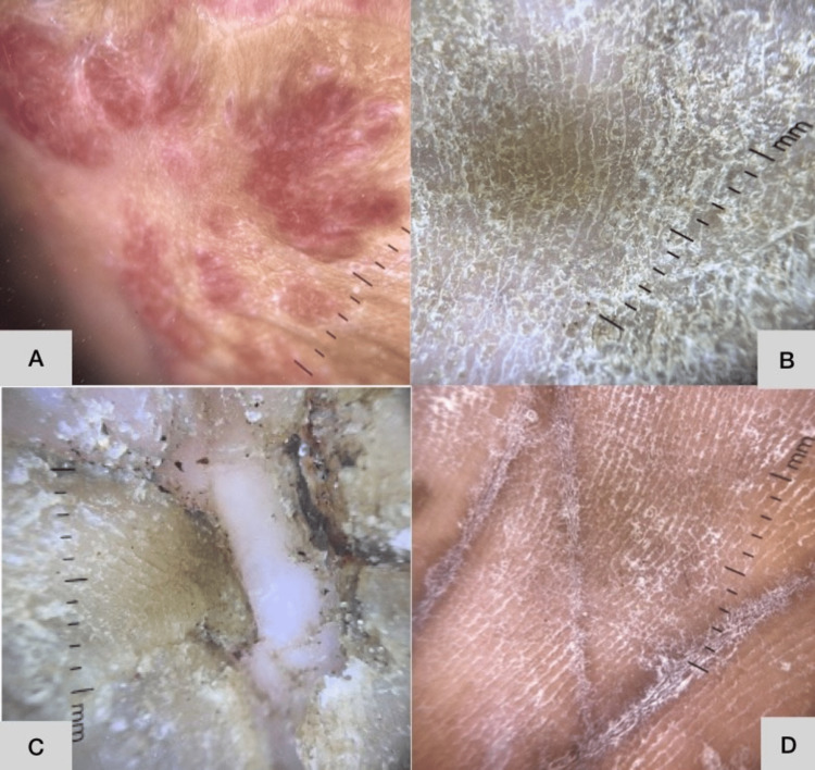 A Clinico Epidemiological Study Of Hyperkeratotic Palmoplantar Lesions