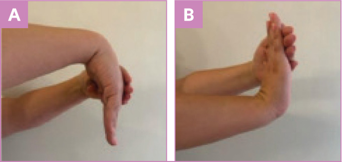 Potential Effects Diagnosis And Management Of De Quervain