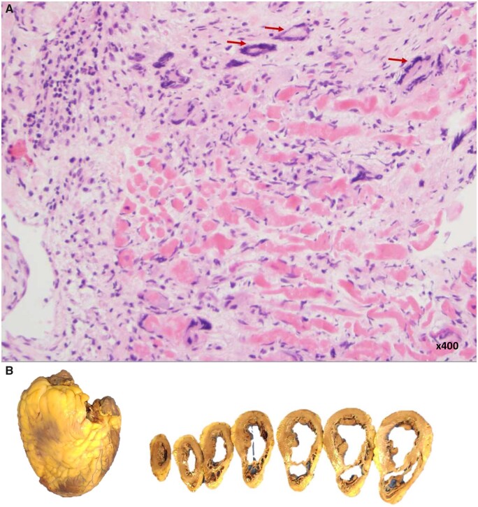 Case Report Of Heart Transplantation For Giant Cell Myocarditis In A