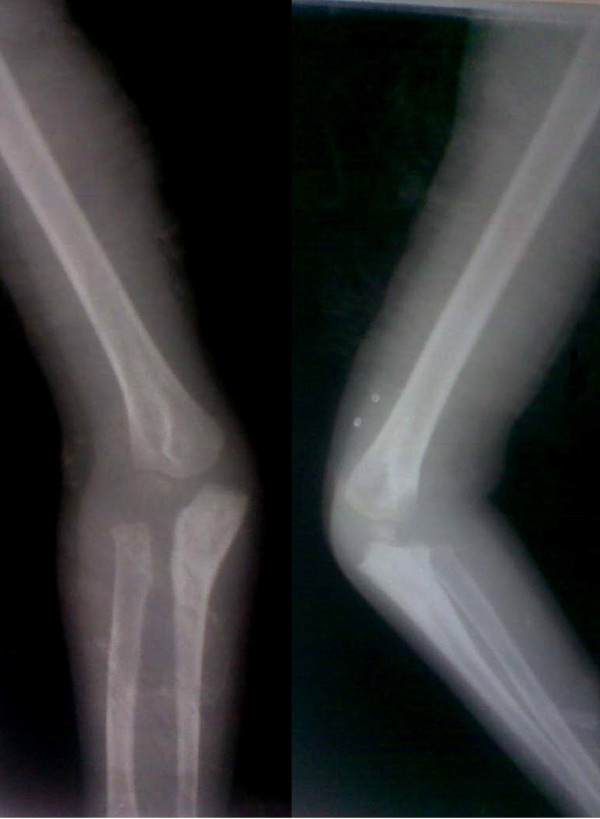 Stable Relocation Of The Radial Head Without Annular Ligament