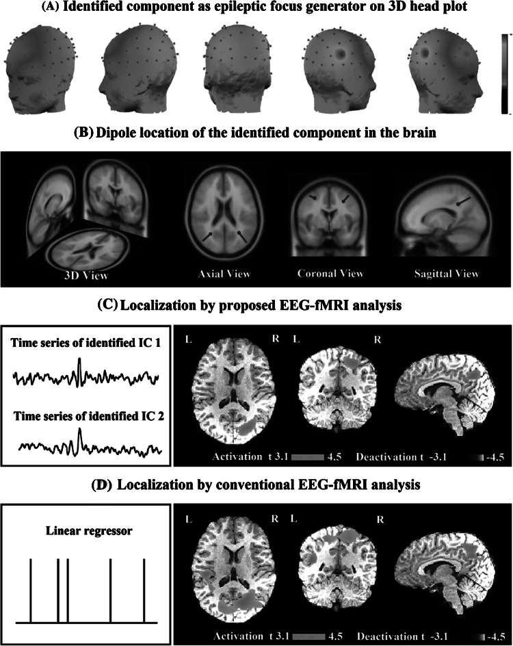 Localizing Confined Epileptic Foci In Patients With An Unclear Focus Or