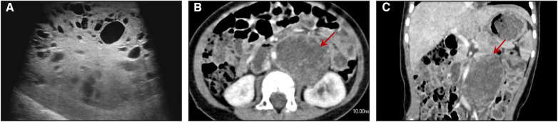 Rare Pediatric Synchronous Bilateral Testicular Germ Cell Tumors Of