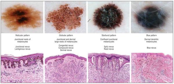 Using Dermoscopic Criteria And Patient Related Factors For The