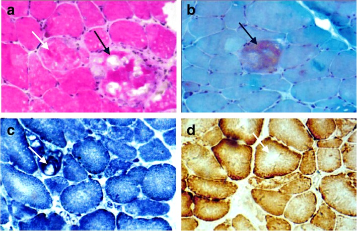 A Case Report A Heterozygous Deletion Del In Exon Of