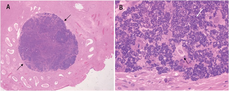 Tumor Like Appearance Of Spermatic Granuloma PMC