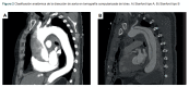Figura 2 Clasificación anatómica de la disección de aorta en tomografía computarizada de tórax.