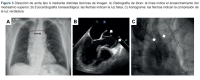Figura 3 Disección de aorta tipo A mediante distintas técnicas de imagen.
