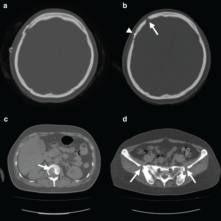 Adult Langerhans Cell Histiocytosis Diagnosed By Biopsy Of The Skull 