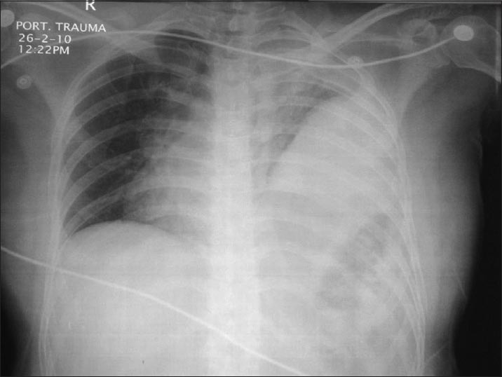 Seatbelt versus seatbelt and airbag injuries in a single motor vehicle ...