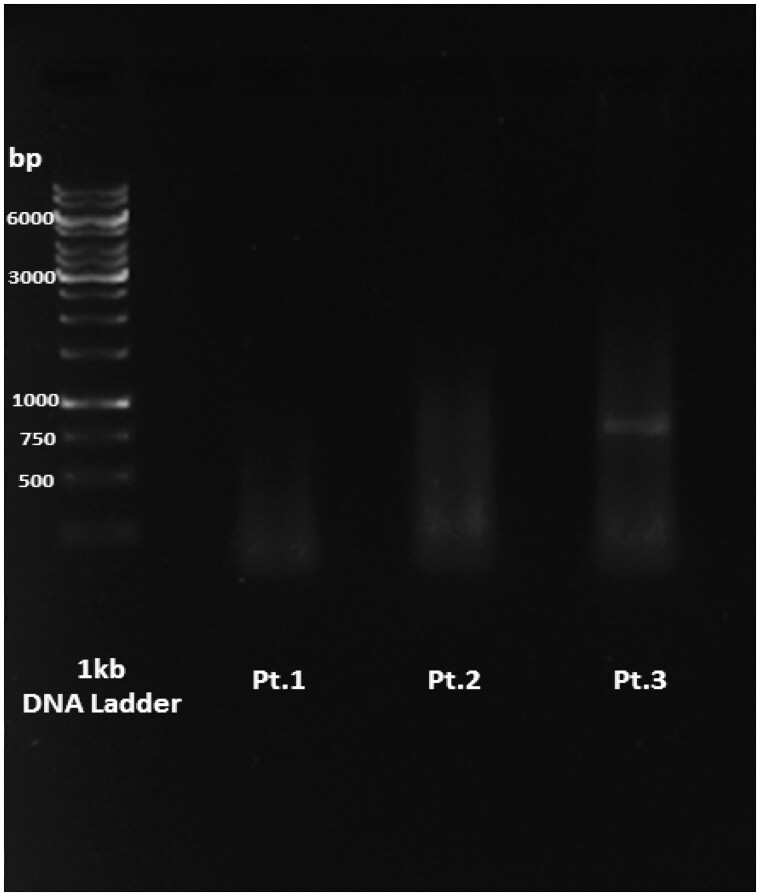 Picture of an agarose gel showing PCR failure or suboptimal results, including lack of a clearly visible amplicon band in two patients or presence of a fait band of the expected size in another patient.