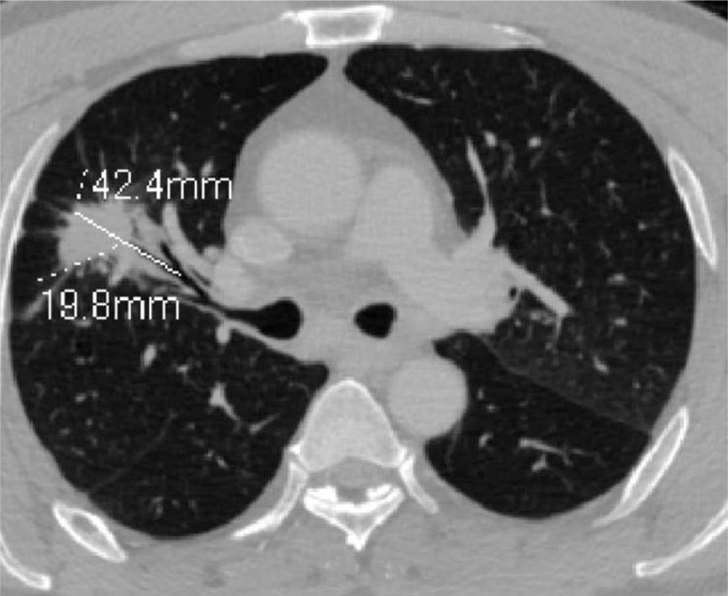 The value of the air bronchogram sign on CT image in the identification ...