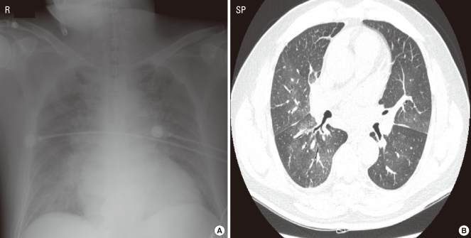 Bronchospasm and Anaphylactic Shock Following Lidocaine Aerosol ...