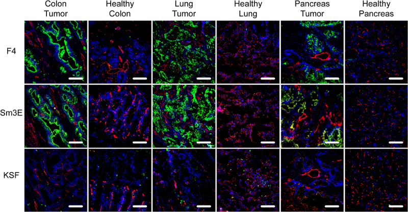 Immunofluorescence staining of a colon tumor, healthy colon, lung tumor, healthy lung, pancreas tumor, and healthy pancreas with the antibodies F4, Sm3E, and KSF. Strong green staining is present in the colon tumor and lung tumor with antibodies F4 and Sm3E and in slightly lower intensity in the pancreas tumor. No green staining is present with KSF and in all healthy organs.