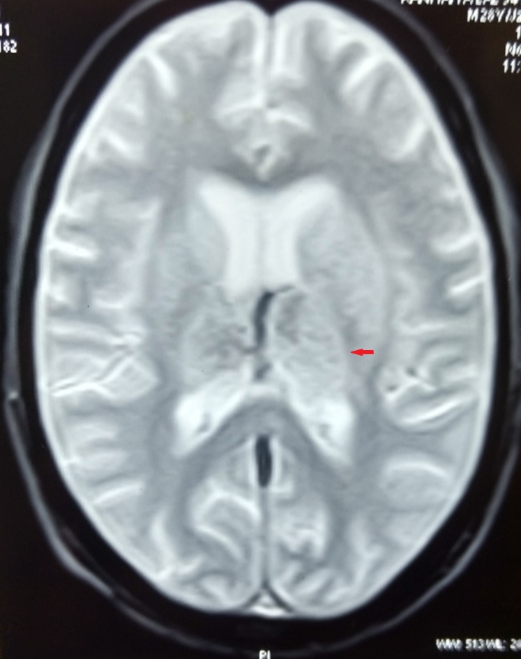 Deep Cerebral Vein Thrombosis: A Clinical Masquerader - Pmc