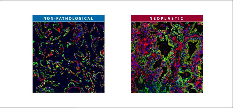 Stromal Dynamic Reciprocity in Cancer: Intricacies of Fibroblastic-ECM ...