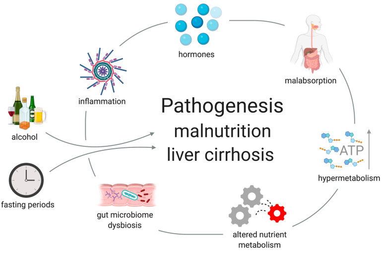 Malnutrition in Patients with Liver Cirrhosis - PMC