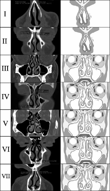 Effectiveness of endoscopic septoplasty in different types of nasal ...