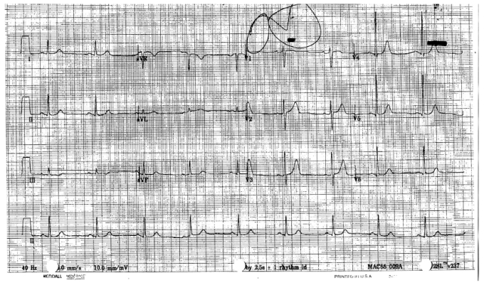 Capecitabine-induced cardiotoxicity: case report and review of the ...