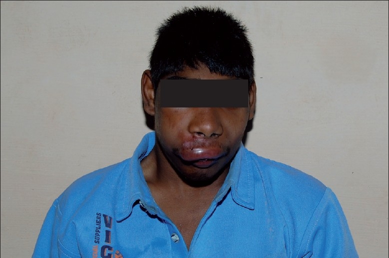 Oral myiasis caused by Chrysomya bezziana - PMC