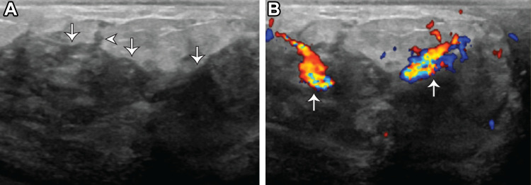 Recurrent granulomatous mastitis in a 32-year-old woman with a history of biopsy-proven granulomatous mastitis, now 4 months pregnant, who presented with right breast pain and drainage. (A) Gray-scale US image shows a complicated fluid collection or phlegmon (arrows) with tubular extension to the skin (arrowhead). (B) Color Doppler US image shows increased vascularity (arrows). Clinical follow-up and management was recommended given the patient's symptoms and history supporting the diagnosis of granulomatous mastitis (BI-RADS 2).