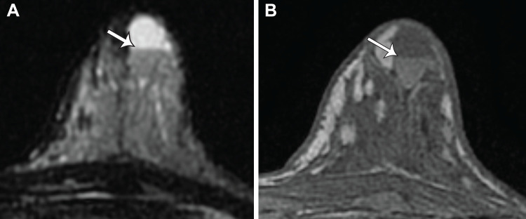Incidental galactocele in a 34-year-old lactating woman at high risk (BRCA2 mutation). Axial fat-saturated T2-weighted (A) and precontrast non–fat-saturated T1-weighted (B) MR images show a complicated cyst in the left breast, with a fat-fluid level (arrow) consistent with that of a galactocele (BI-RADS 2). Note that the fat component is posterior because the patient was imaged in the prone position.