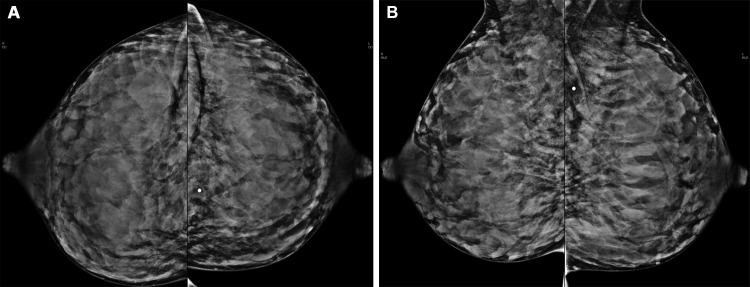 Normal mammographic appearance of the breasts in a 33-year-old lactating woman who presented with a palpable abnormality in the left breast. Bilateral craniocaudal (A) and mediolateral oblique (B) mammograms show symmetric increased parenchymal density (breast composition category D, extremely dense). No underlying mammographic abnormality is identified. The palpable area of concern corresponded with normal breast tissue on US images (not shown).