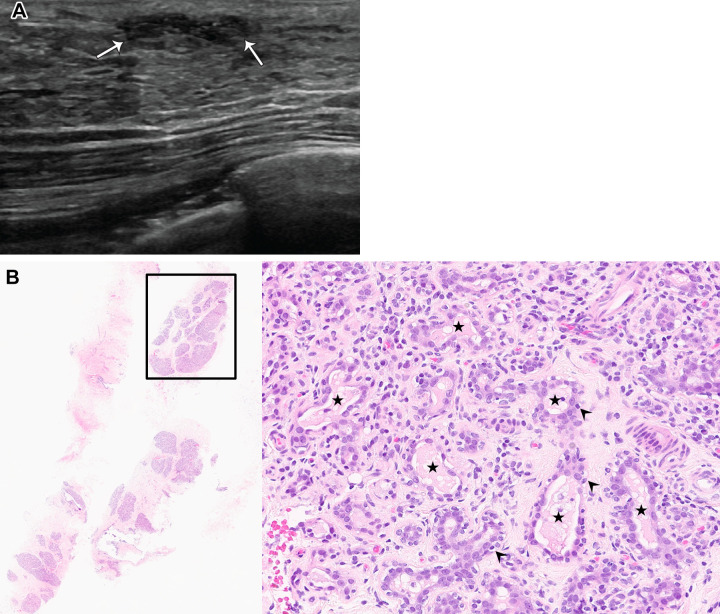 Lactational changes in a 33-year-old lactating woman who presented with a palpable abnormality in the left breast. Mammogram (not shown) showed no underlying abnormality. (A) US image shows an oval hypoechoic mass with indistinct margins (arrows), which correlated with the palpable mass reported by the patient. The mass was categorized as BI-RADS 4A, and US-guided biopsy was subsequently performed. (B) Photomicrographs show cores with variably sized acini (left) and variably dilated acinar units (★, right) in lobules containing intraluminal secretions consistent with lactational changes. Note preservation of outer myoepithelial layers (arrowheads, right). (Hematoxylin-eosin stain; original magnification, left, ×4; right, ×200.)
