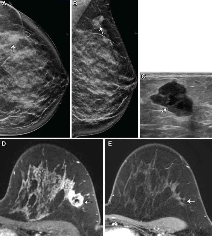 PABC in a 31-year-old woman who presented with a left breast lump. (A, B) Craniocaudal (A) and mediolateral oblique (B) mammograms show an irregular mass in the left breast, with indistinct margins (arrows), that corresponds with the overlying triangular marker in A. (C) US image shows a corresponding irregular hypoechoic mass with angular margins (arrow) (BI-RADS 4C). US-guided biopsy results revealed grade 3 estrogen receptor–negative, progesterone receptor–negative, HER2–negative invasive ductal carcinoma. The patient subsequently discovered that she was pregnant but decided to terminate the pregnancy. MRI was performed after termination to evaluate for the extent of the disease. (D) Axial contrast-enhanced T1-weighted MR image shows the biopsy-proven malignant mass with a susceptibility artifact from the biopsy clip (arrow). No lymphadenopathy was seen. (E) Post–neoadjuvant chemotherapy contrast-enhanced T1-weighted MR image at the same level shows no residual mass or enhancement at the site of the biopsy-proven malignancy (arrow). The final pathologic results showed benign breast parenchyma with treatment effects and three negative sentinel lymph nodes.