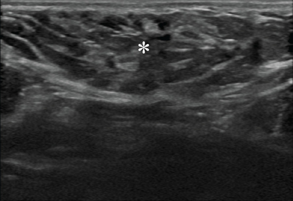 Accessory axillary breast tissue in a 36-year-old pregnant woman who presented with a right axillary lump for 2 months. US image shows heterogeneous echogenic tissue (*), similar to normal fibroglandular tissue, consistent with accessory axillary breast tissue (BI-RADS 2).