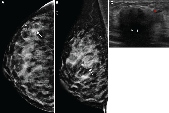 Atypical appearance of a galactocele in a 30-year-old lactating woman 6 months after giving birth who presented with a palpable lump in her right breast. Craniocaudal (A) and mediolateral (B) mammograms of the right breast show an oval mass with obscured margins (arrow). (C) Color Doppler US image at the site of the palpable lump shows a mass with a heterogeneous echotexture, indistinct margins, and posterior acoustic shadowing (*), without internal vascularity (BI-RADS 4A). US-guided aspiration yielded milky fluid diagnostic of a galactocele. Subsequent core biopsy due to persistence of a palpable mass after repeated aspirations showed benign lactational changes.