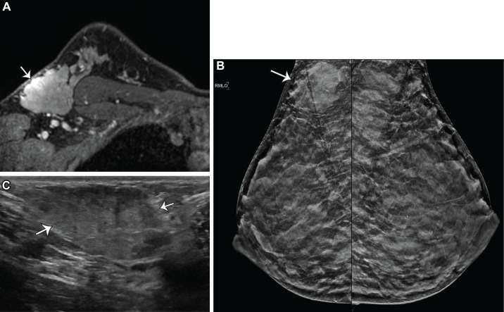 Incidental accessory axillary breast tissue in a 36-year-old lactating woman at high risk, with a family history of breast cancer. (A) Axial contrast-enhanced T1-weighted MR image shows an enhancing mass with irregular margins in the right axillary tail (arrow). Evaluation of the contrast-enhancement kinetics showed rapid initial phase and delayed phase washout (not shown). (B) Bilateral mediolateral oblique mammograms show an irregular mass in the right axillary tail region (arrow). (C) Targeted US image of the right axilla shows an irregular heterogeneous mass with indistinct margins (arrows), which was categorized as BI-RADS 4A. US-guided biopsy of the mass confirmed benign breast tissue with lactational change.