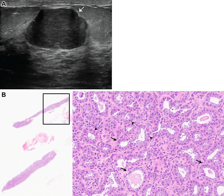 Lactating adenoma in a 26-year-old pregnant woman at 28-weeks gestation who presented with a palpable lump in the subareolar region of her right breast. (A) US image shows an oval hypoechoic mass with microlobulated margins (arrow) and posterior acoustic enhancement. This was categorized as BI-RADS 4A, and US-guided biopsy was subsequently performed. (B) Photomicrographs show markedly hypercellular cores (left) and marked hyperplasia of normal-appearing lactational tissue (right), consistent with a lactating adenoma. Note minimal intervening stroma due to marked acinar expansion. However, the basement membrane remains visible (arrows, right). A myoepithelial cell layer is present but inconspicuous (arrowheads, right) due to the increase in the size and volume of epithelial cells, with finely vacuolated cytoplasms. (Hematoxylin-eosin stain; original magnification, left, ×4; right, ×200.)