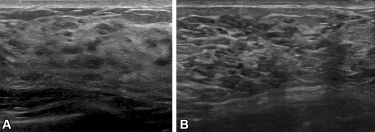 Normal US appearance of the breasts during pregnancy and lactation in two patients. (A) US image in a 30-year-old pregnant patient at 15 weeks gestation shows diffusely hypoechoic and heterogeneous fibroglandular tissue. (B) US image in a lactating patient shows that the fibroglandular tissue is diffusely echogenic, with prominent ducts.