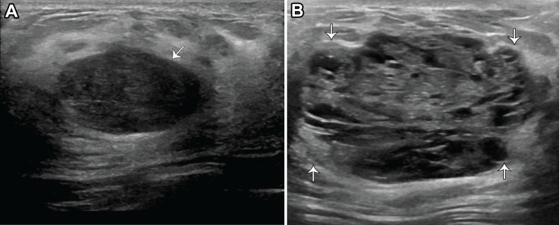Fibroadenoma with lactational changes in a 32-year-old woman who presented with a lump in her left breast. (A) US image acquired at 15 weeks gestation shows an oval hypoechoic mass with circumscribed margins (arrow) and posterior acoustic enhancement, which was categorized as BI-RADS 3, with short-interval follow-up recommended. (B) Follow-up postpartum US image acquired while the patient was breastfeeding shows an interval increase in the size and heterogeneity of the mass (arrows). The mass was recategorized as BI-RADS 4A, and subsequent US-guided biopsy results confirmed the diagnosis of a fibroadenoma with lactational changes.