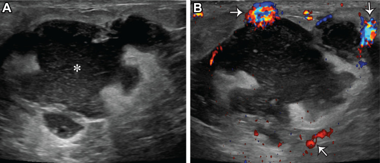 Acute puerperal abscess in a 26-year-old lactating woman who presented with skin erythema, warmth, and pain. (A) Gray-scale US image shows an irregular complicated fluid collection (*). (B) Color Doppler US image shows hyperemia surrounding the fluid collection (arrows). US-guided aspiration yielded purulent fluid, and cultures grew methicillin-resistant Staphylococcus aureus (MRSA).