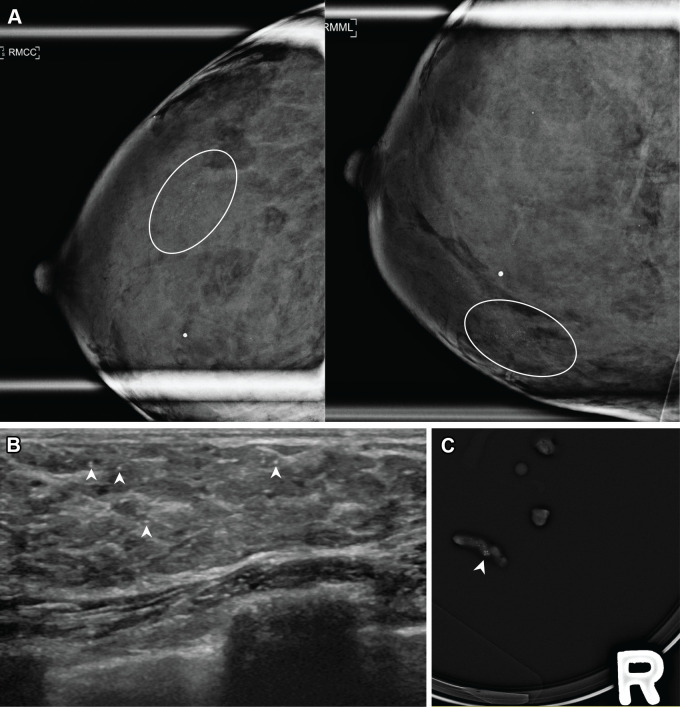 Lactational changes in a 47-year-old lactating woman with screening-detected calcifications in the right breast. (A) Diagnostic magnification craniocaudal (left) and mediolateral (right) mammographic views of the right breast show grouped amorphous calcifications at 7 o'clock (oval outlined areas). (B) US image of the right breast shows corresponding calcifications with punctate echogenic foci (arrowheads). The calcifications were categorized as Breast Imaging Reporting and Data System (BI-RADS) 4B. Because the patient was lactating and there was concern for formation of a milk fistula with stereotactic-guided biopsy, US-guided biopsy of the suspicious calcifications in the right breast was performed. (C) Specimen radiograph of the cores obtained from the right breast US-guided biopsy show representative calcifications (arrowhead). Pathologic examination showed benign breast tissue with lactational changes associated with calcifications.