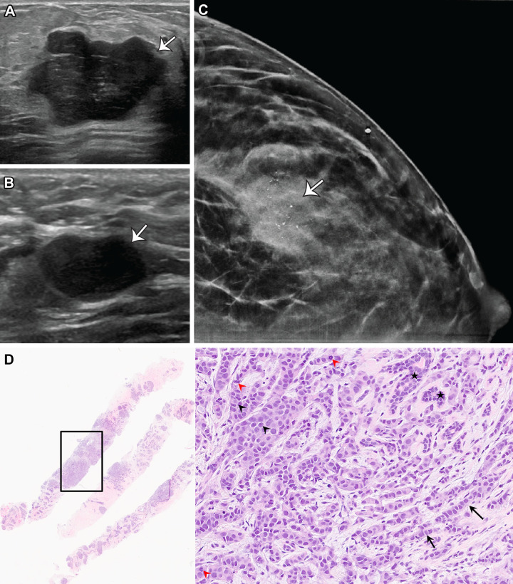 PABC in a 36-year-old pregnant woman at 13 weeks gestation who presented with a lump in her left breast. (A) US image of the palpable area of concern shows an irregular hypoechoic mass with angular margins (arrow). (B) US image of the left axilla shows a morphologically abnormal lymph node, with cortical thickening and loss of fatty hilum (arrow). (C) Mammogram of the left breast shows an irregular mass with indistinct margins and associated fine pleomorphic calcifications (arrow) that corresponds to the mass seen on US images. The breast mass was categorized as BI-RADS 5, and US-guided biopsy results confirmed the diagnosis of grade 3 estrogen receptor–positive, progesterone receptor–positive, HER2–negative invasive ductal carcinoma,. The lymph node was also biopsied and demonstrated metastatic carcinoma. (D) Photomicrographs of the left breast mass specimen show an infiltrative hypercellular core (left) and irregular angulated nests (black arrowheads) and cords (arrows) of tumor cells infiltrating the stroma, with a desmoplastic reaction, in a haphazard arrangement (right), with a mitotic figure (red arrowheads). Note the intact myoepithelial cell layer in entrapped lobules for comparison (★, right). (Hematoxylin and eosin stain; original magnification, left, ×4; right, ×200.)