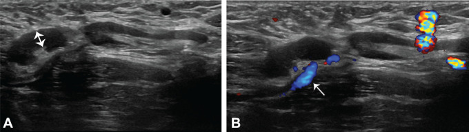 Benign reactive lymph nodes in a 34-year-old lactating woman who presented with a palpable abnormality in the right axilla after recent ipsilateral COVID-19 vaccination. A mammogram was negative for abnormality (not shown). (A) Gray-scale US image shows prominent lymph nodes in the right axilla, with uniform cortical thickening measuring up to 6 mm (double-headed arrow). The morphology of the lymph nodes is otherwise normal, with preserved fatty hila. (B) Color Doppler US image shows hilar vascularity (arrow). The findings are consistent with reactive lymphadenopathy due to recent ipsilateral vaccination (BI-RADS 2). The patient received clinical follow-up, with no palpable abnormality on physical examination.