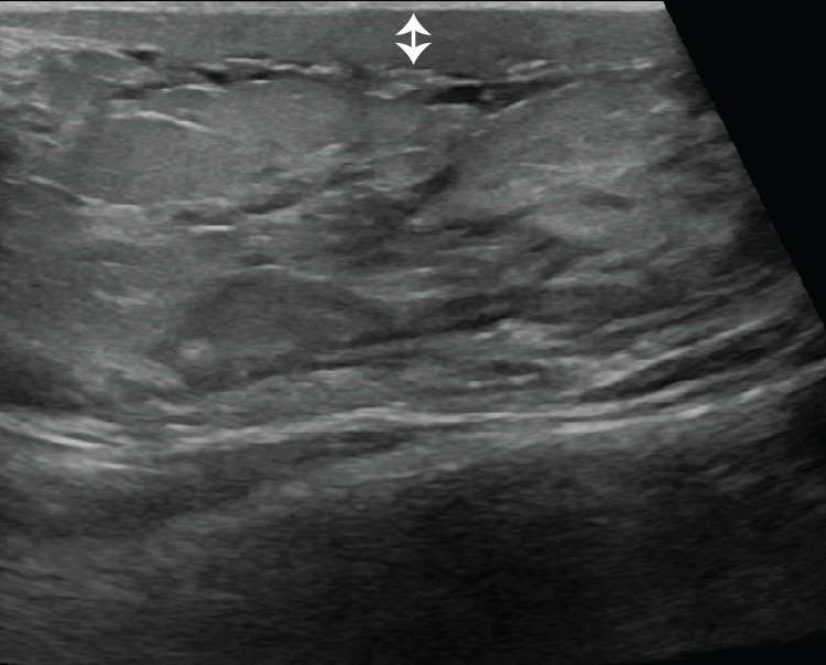 Puerperal mastitis in a 28-year-old woman who presented with skin erythema and pain after discontinuing breastfeeding 3 weeks earlier. US image shows skin thickening (double-headed arrow) and subcutaneous edema with no discrete fluid collection. Given the patient's presenting symptoms and imaging features compatible with mastitis, a BI-RADS 2 category was assigned. The patient improved with antibiotic treatment and received clinical follow-up to resolution.