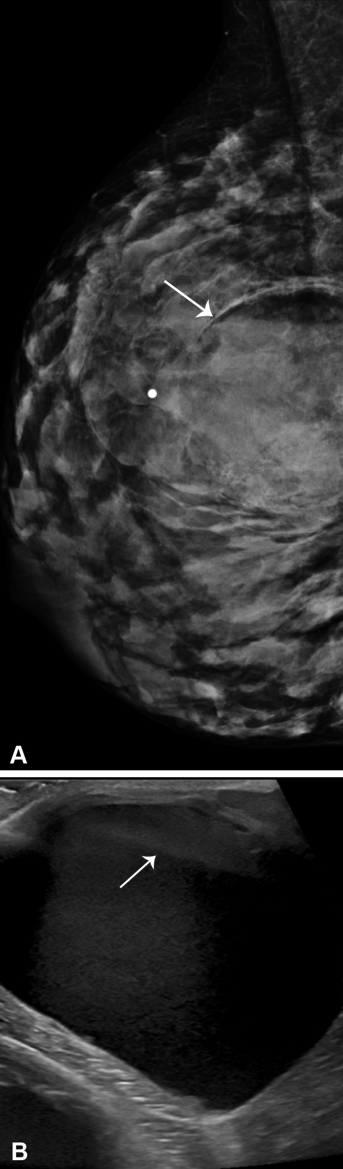 Galactocele in a 30-year-old lactating woman who presented with a palpable lump in her right breast. (A) Mediolateral mammogram shows an oval circumscribed mass with a fat-fluid level (arrow). (B) US image also shows the fat-fluid level (arrow), with echogenic fat occupying the nondependent portion of the cyst. The imaging features are characteristic of a galactocele (BI-RADS 2). US-guided aspiration for symptomatic relief yielded milky fluid.