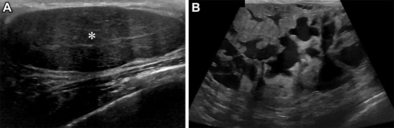 Fibroadenoma with lactational changes in a 34-year-old lactating woman who presented with an enlarging right breast lump at the site of biopsy-proven fibroadenoma. (A) US image acquired 4 years earlier when the patient was not lactating shows an oval hypoechoic mass with circumscribed margins (*). US-guided biopsy (not shown) showed a benign fibroadenoma. (B) US image acquired at presentation when the patient was lactating shows the substantially increased size of the mass, with new internal cystic spaces and indistinct margins. Due to the complex cystic and solid mass appearance and interval growth of the mass, excisional biopsy was ultimately performed, and the result confirmed the diagnosis of a fibroadenoma with lactational changes.