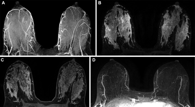 Normal MRI appearance of the breasts in a high-risk 36-year-old lactating woman with a family history of breast cancer. (A) Axial maximum intensity projection MR image shows marked bilateral background parenchymal enhancement and increased vascularity. (B) Axial fat-saturated T2-weighted MR image shows diffuse increased signal intensity. (C) Axial fat-saturated early phase contrast-enhanced MR image shows an increased amount of fibroglandular tissue. (D) Maximum intensity projection MR image acquired in the patient before pregnancy and lactation shows only mild background parenchymal enhancement.