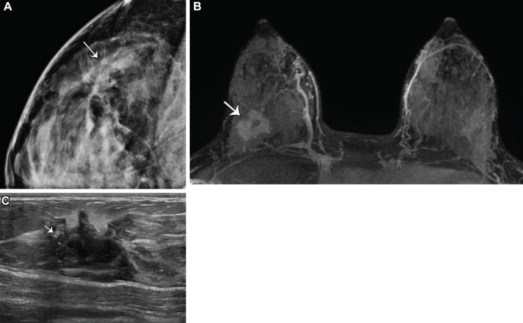 Pregnancy-associated breast cancer in a 32-year-old lactating woman who presented with a lump in her right breast. (A) Mammogram shows a focal asymmetry with associated architectural distortion and amorphous calcifications (arrow). (B) US image shows a corresponding irregular hypoechoic mass with angular margins (arrow), which was categorized as BI-RADS 5. US-guided biopsy results confirmed invasive ductal carcinoma, grade 3, estrogen receptor–positive, progesterone receptor–positive, HER2–positive. (C) Maximum intensity projection MR image (acquired to determine the extent of the disease) shows an irregular enhancing mass, consistent with the biopsy-proven malignancy (arrow). No lymphadenopathy was seen. Marked background parenchymal enhancement is also noted.