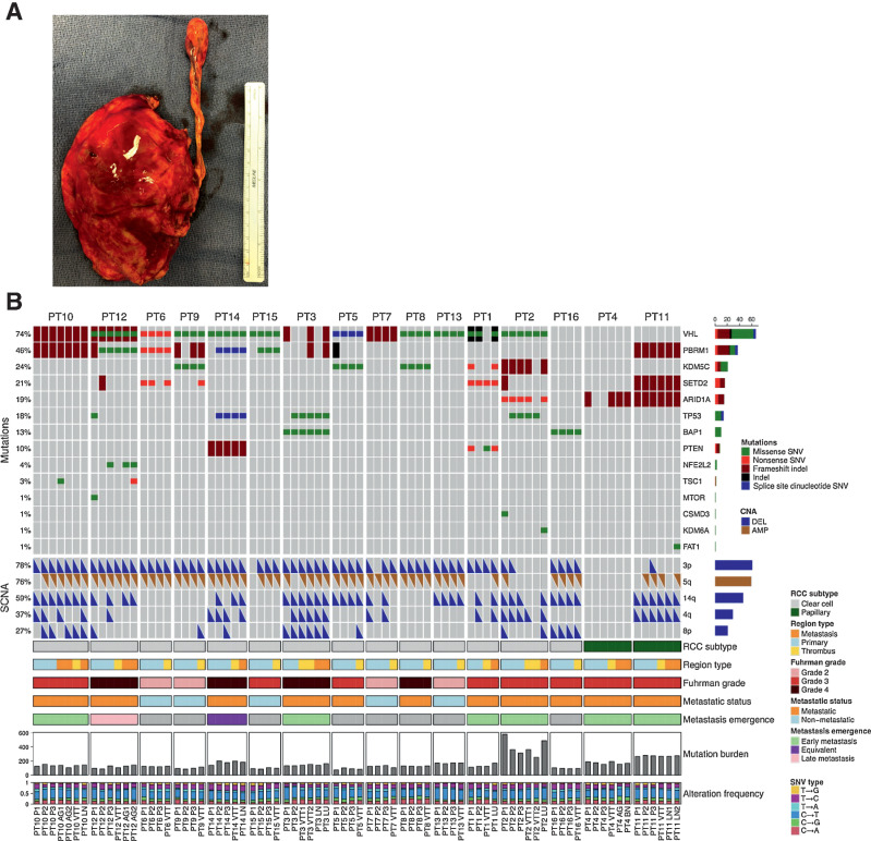 Figure 1. A, Patient kidney and VTT post-nephrectomy with IVC thrombectomy. B, Genomic alteration landscape across tumor regions in 16 patients with RCC with VTT. An oncoprint showing the most prevalent somatic mutations and SCNAs found in this cohort. The prevalence of each alteration is indicated at left. The following are the tumor lesion labels: P, primary tumor; VTT, venous tumor thrombus; AG, adrenal gland metastasis; LN, lymph node metastasis; LU, lung metastasis; BN, brain metastasis.